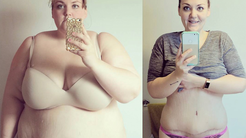 Mallory Buettner Lost 210 Pounds After Weight Loss Surgery To Finally Wear ...